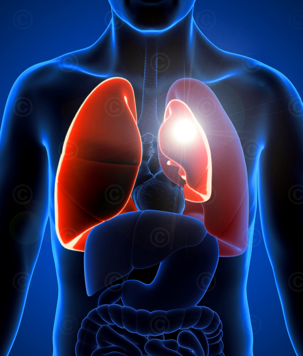 Pneumothorax