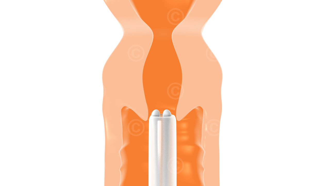 hormonspirale insertion muttermund