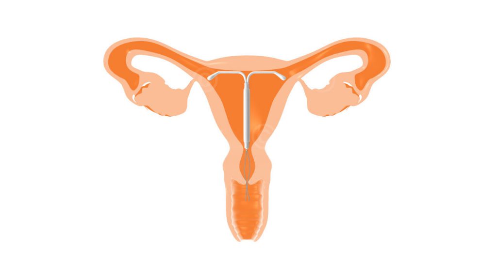 Hormonspirale im Uterus