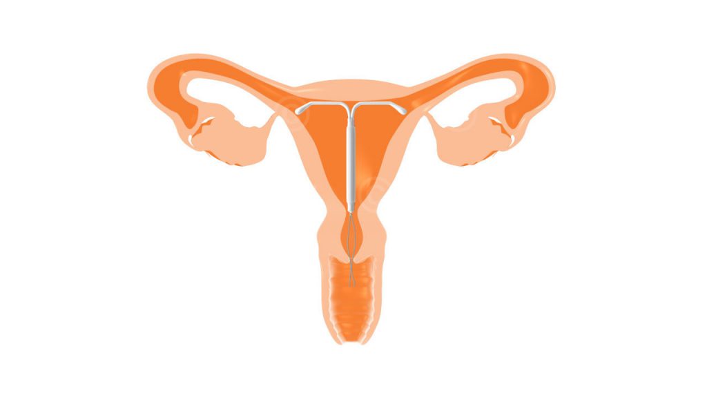Hormonspirale im Uterus
