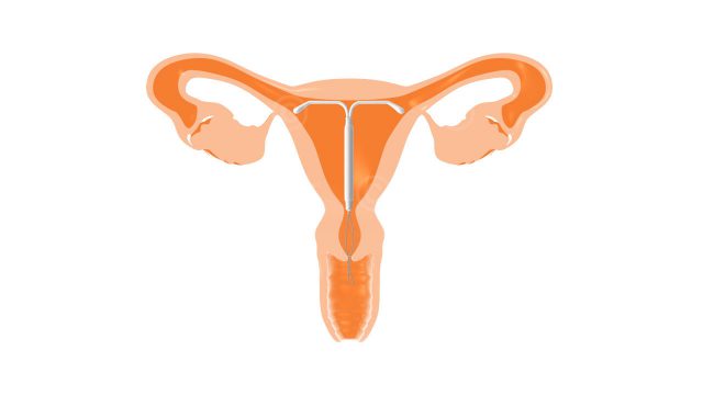 Hormonspirale im Uterus