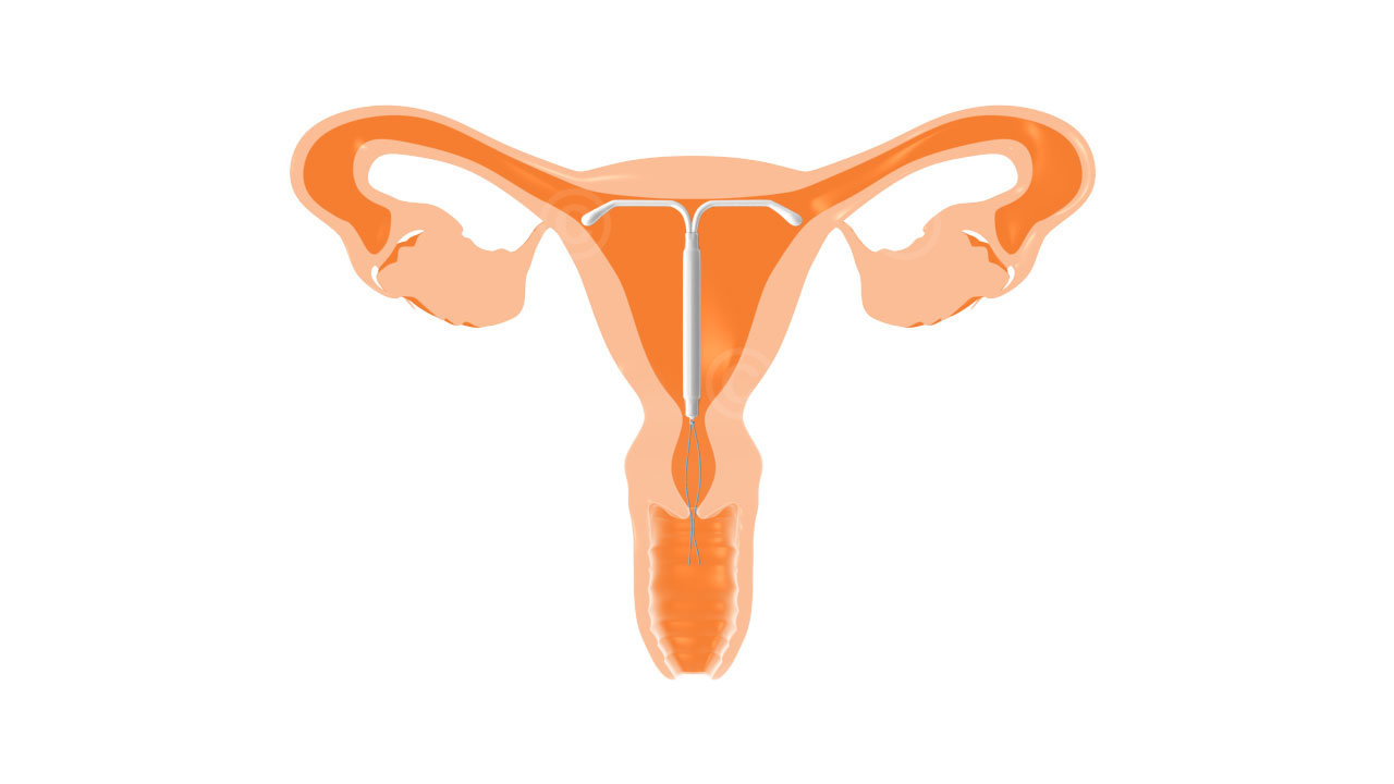 Hormonal IUD in uterus