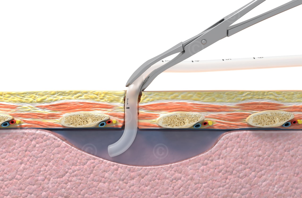 Drainagerohr im Pleuraspalt - Thoraxdrainage