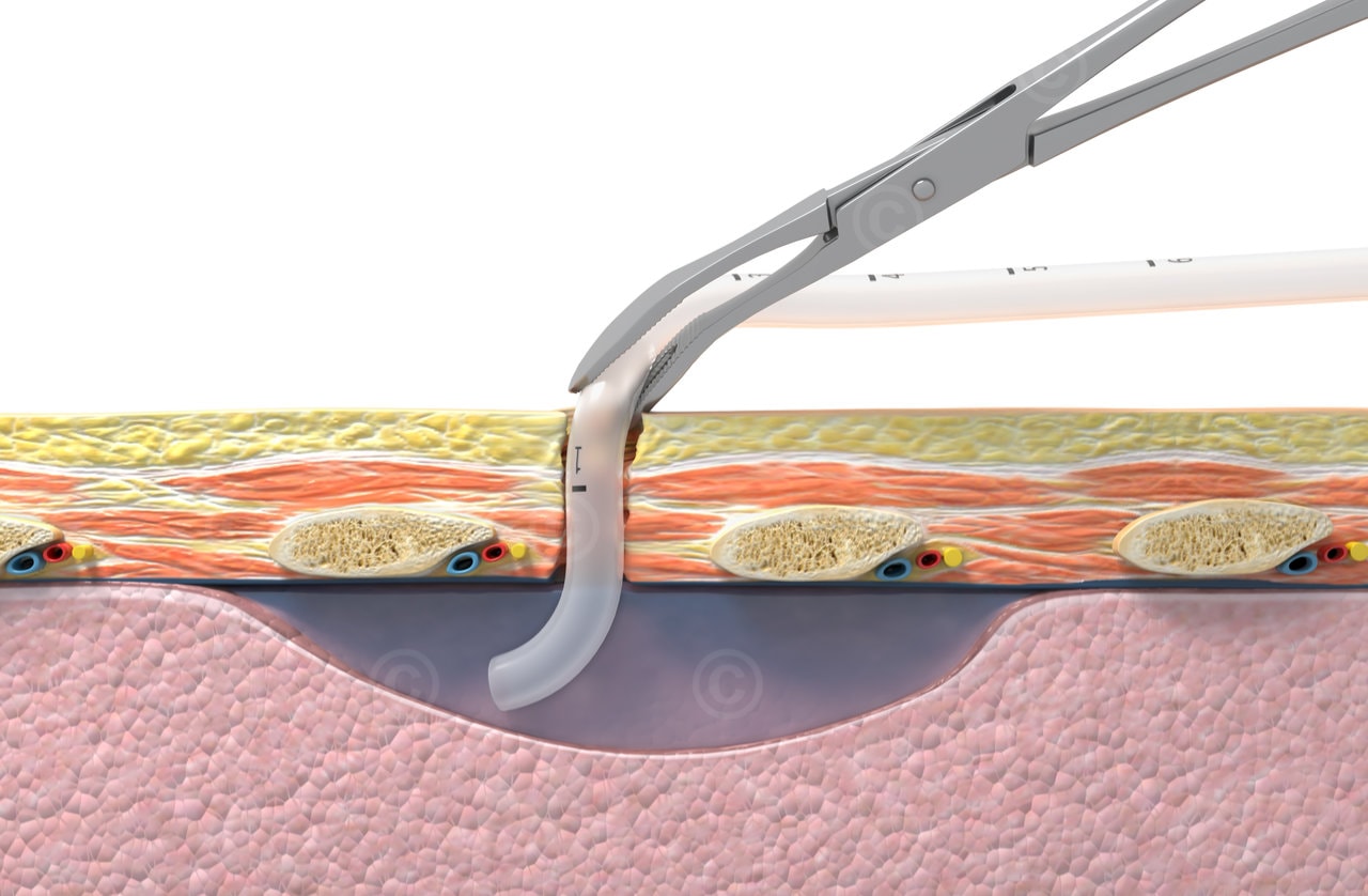 Drainagerohr im Pleuraspalt - Thoraxdrainage