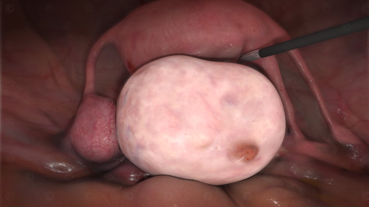 ovarian cyst