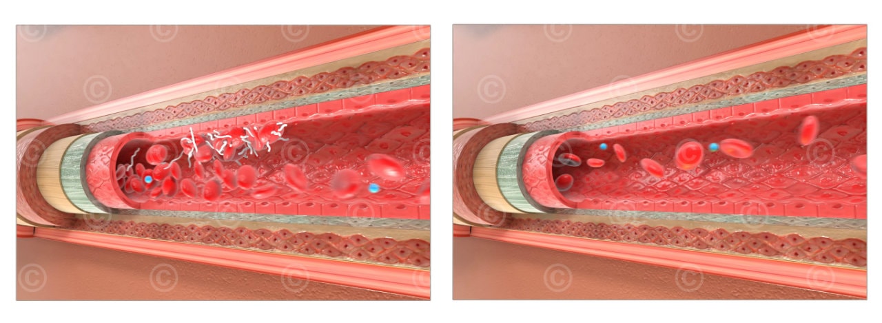 thromboembolische ereignisse