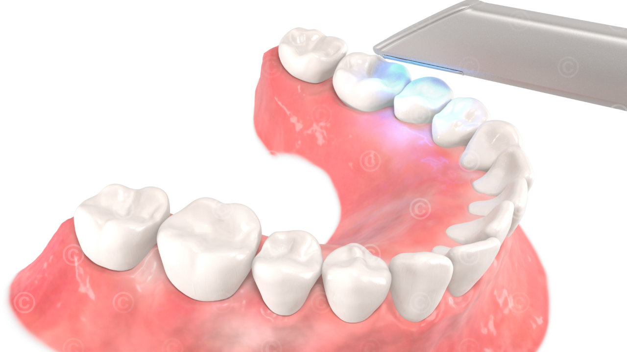 Intraoral 3D scan of the lower jaw