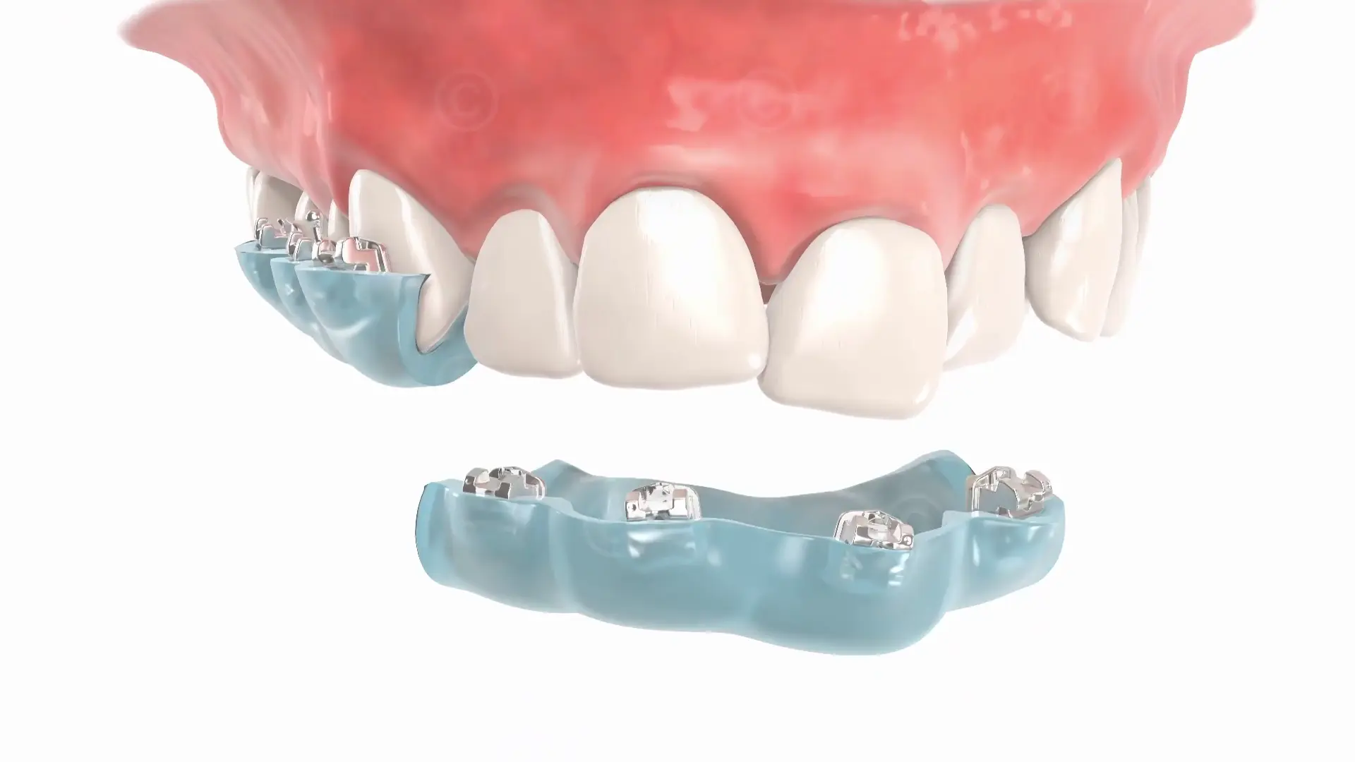 Vorbereitung aufbringen Brackets mit Trays