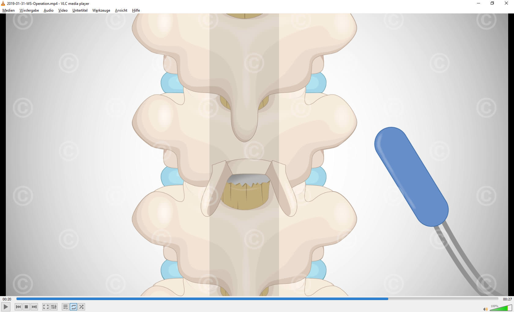 Operation method electrode spinal cord