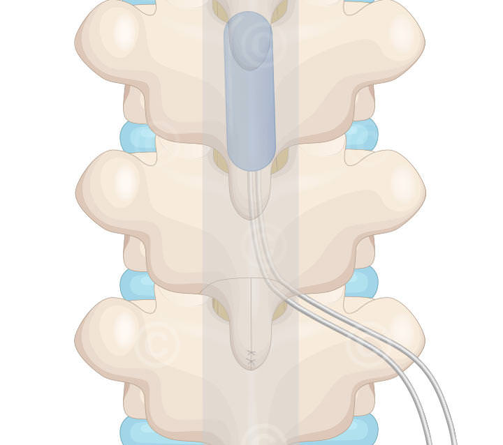 op ergebnis elektrode neurostimulation