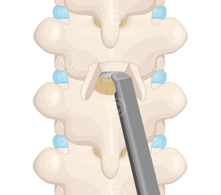 op stanzen dura mater spinalis