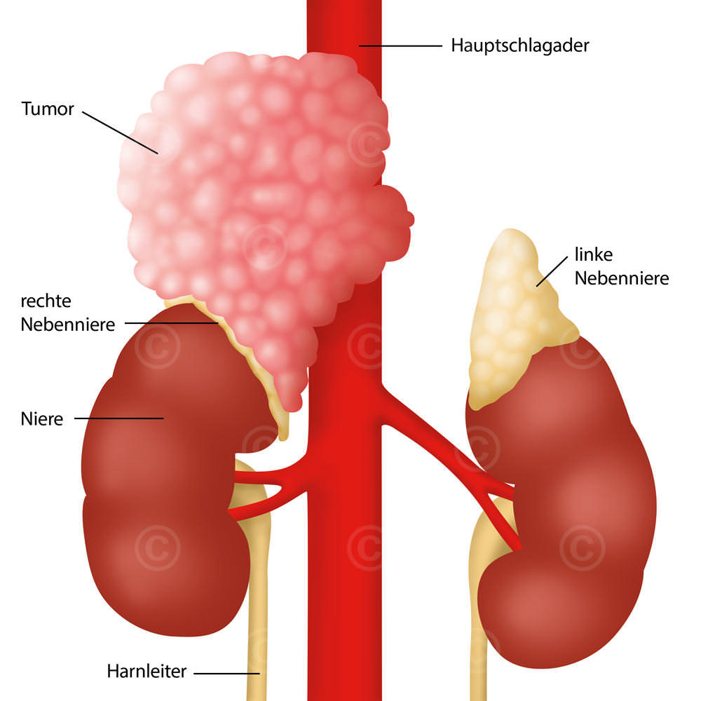 Nebennieren-Tumor