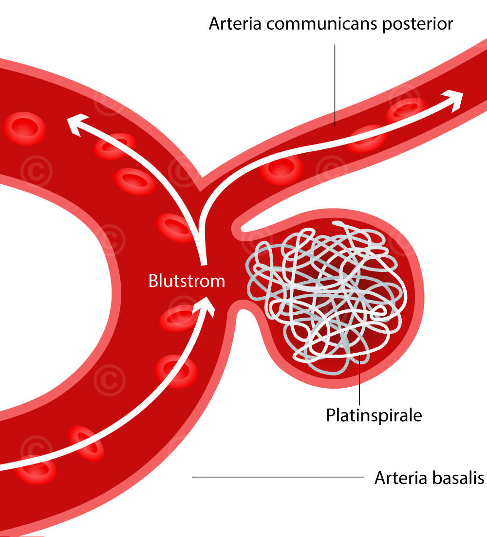 platinspirale blutgefaess Aneurysma