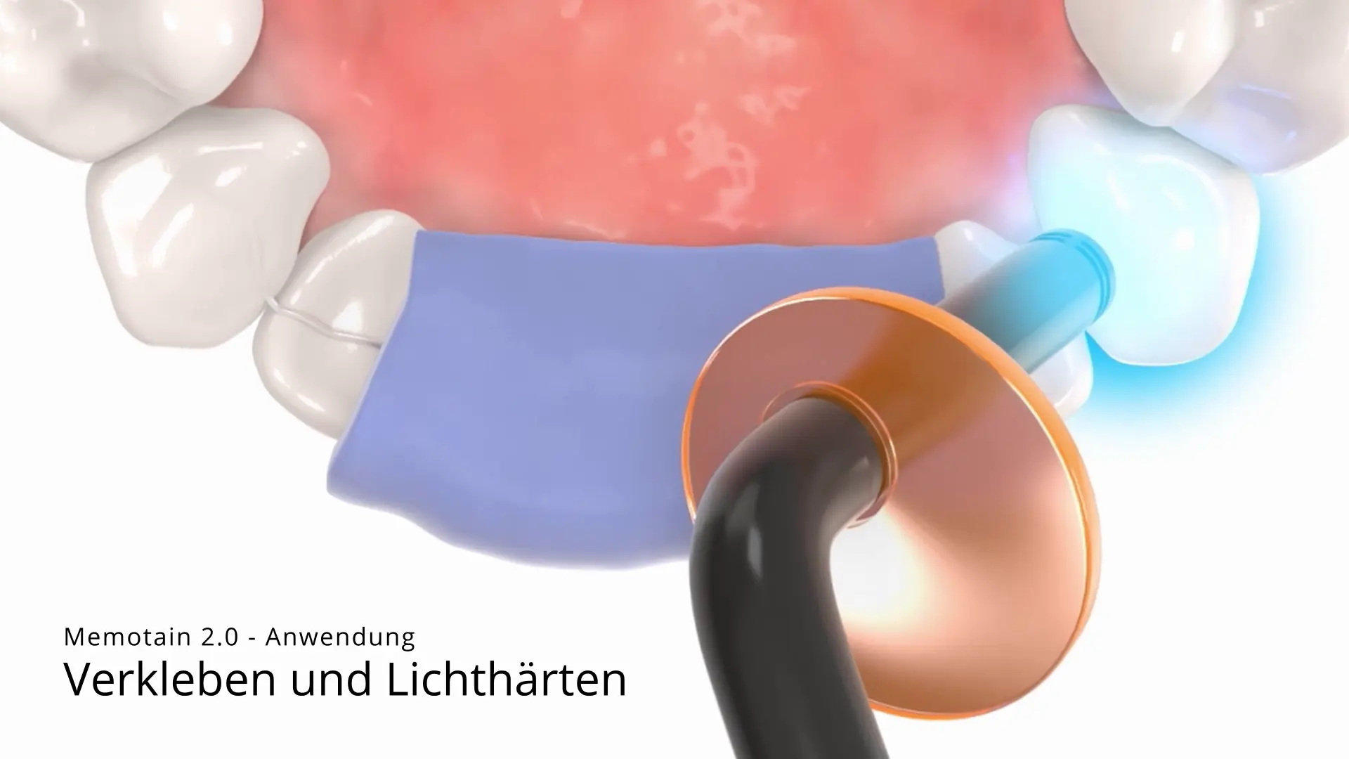 Kleben und Lichthärten Retainer