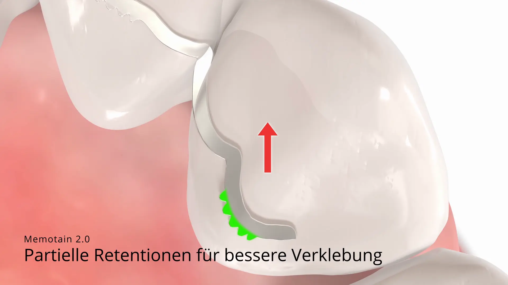 Memotain2 Retentionen