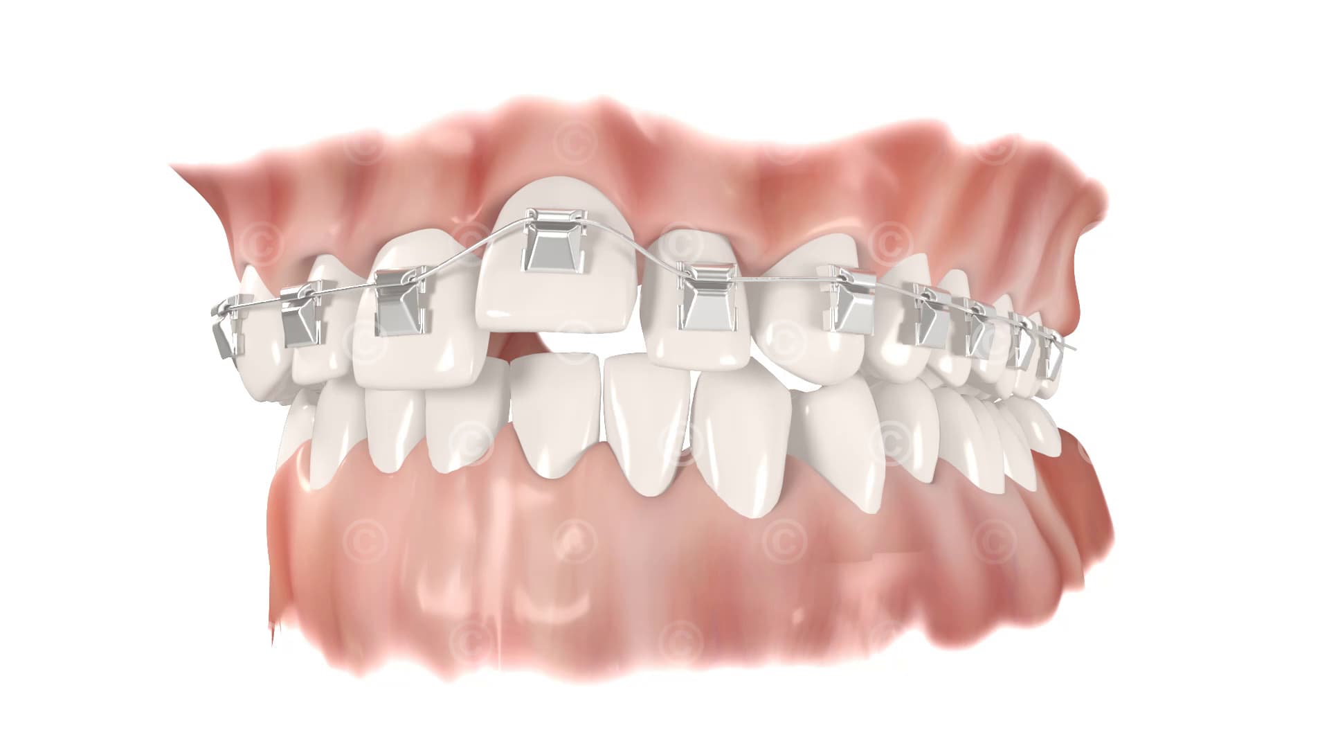 Tooth correction brackets