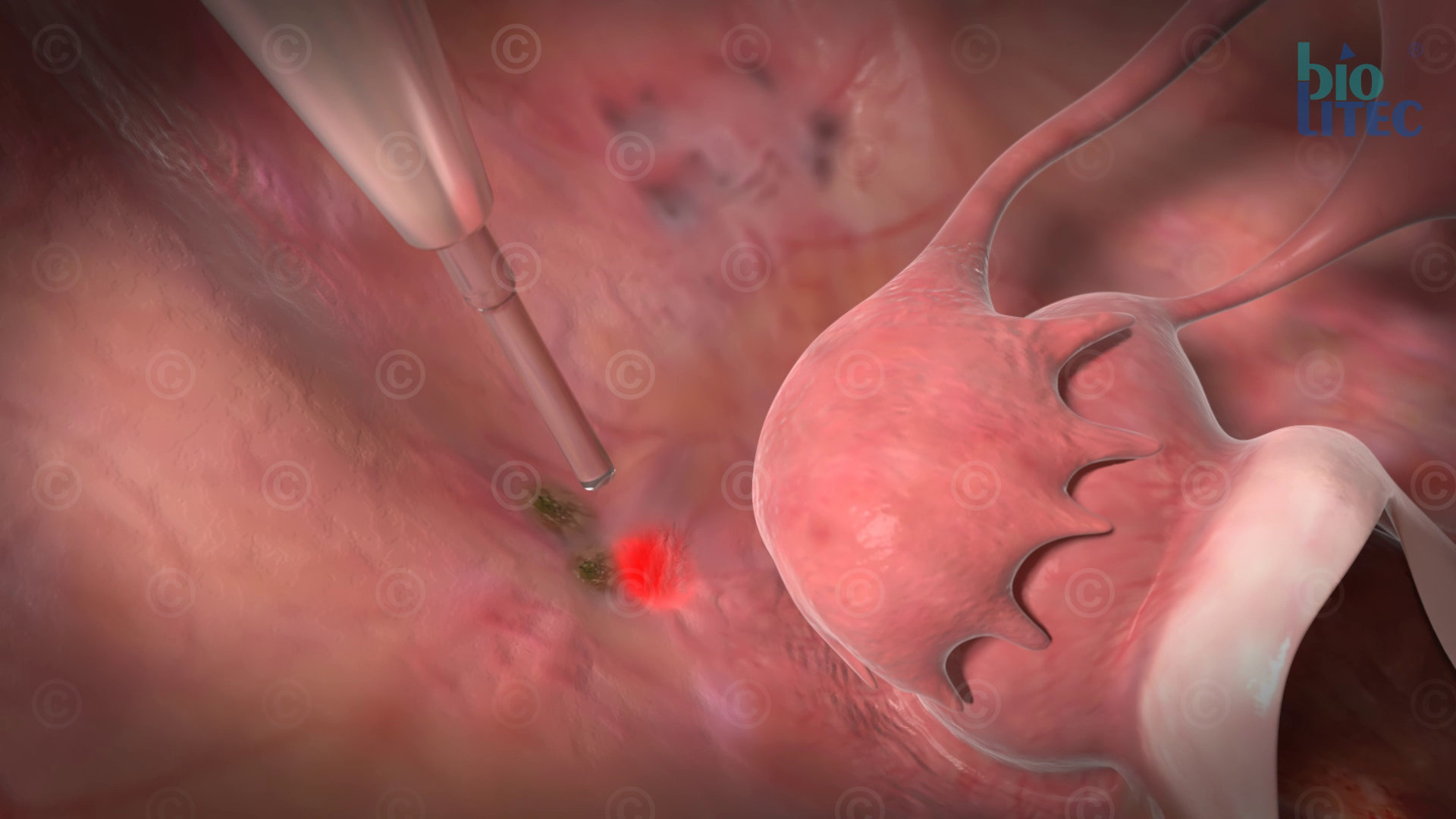 endometriose behandlung laser