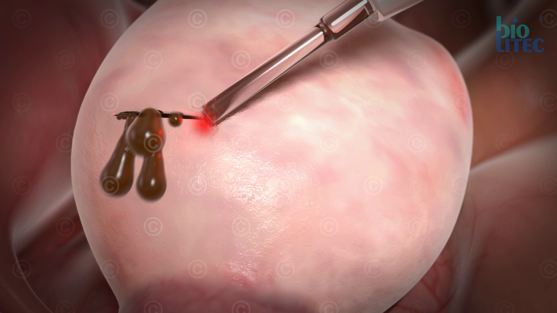 ovarian cyst laser