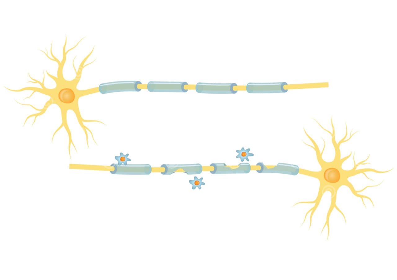 multiple sklerose nerven myelinschicht