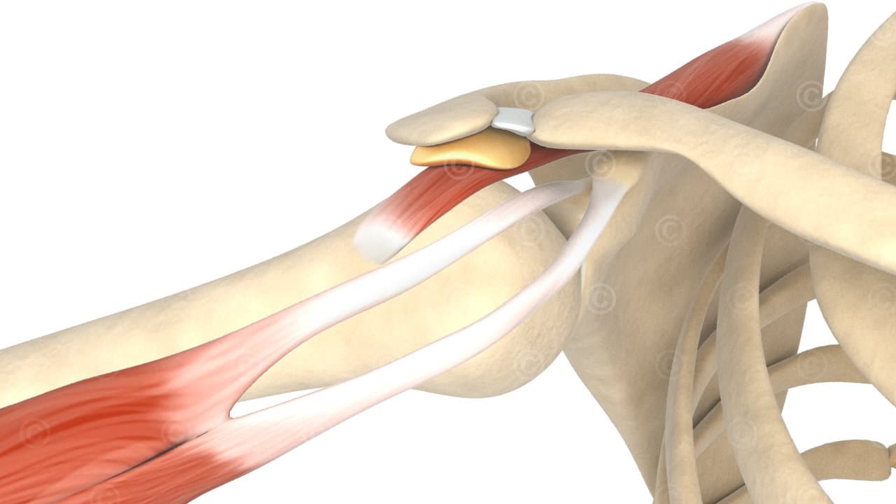 schulter impingement