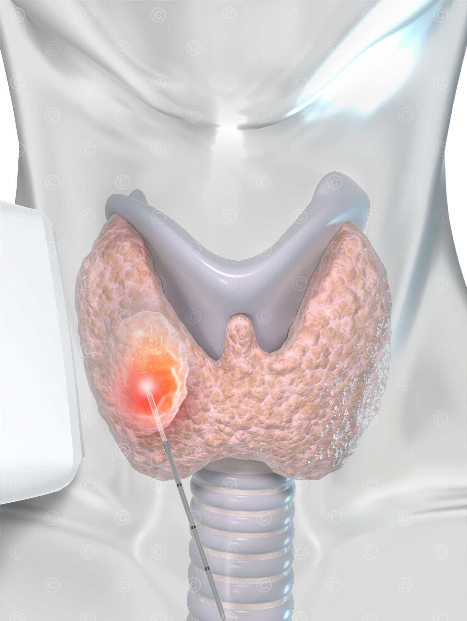 Treatment thyroid noduleswith laser fiber