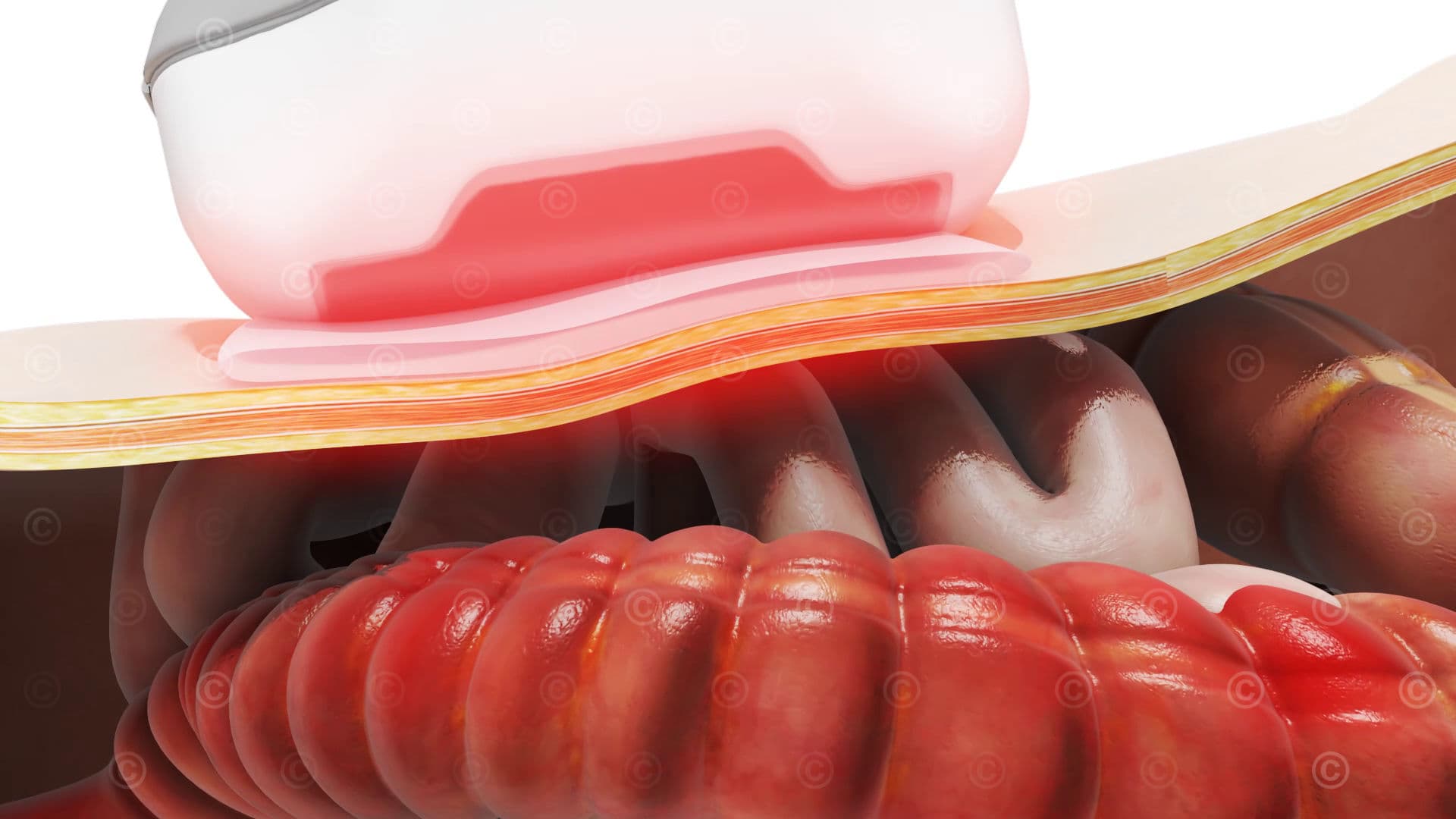 Photoacoustic examination intestine