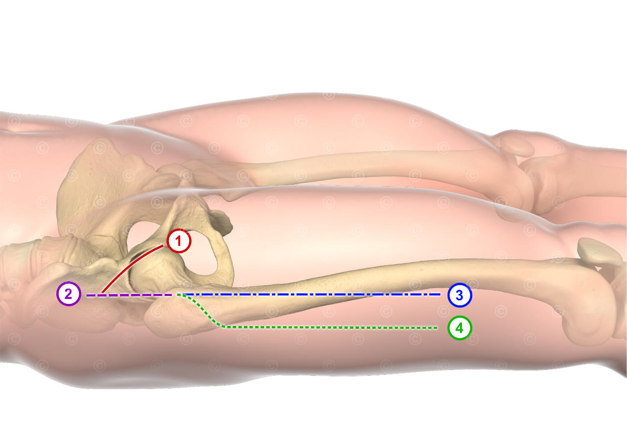 Incisions hip surgery - publication