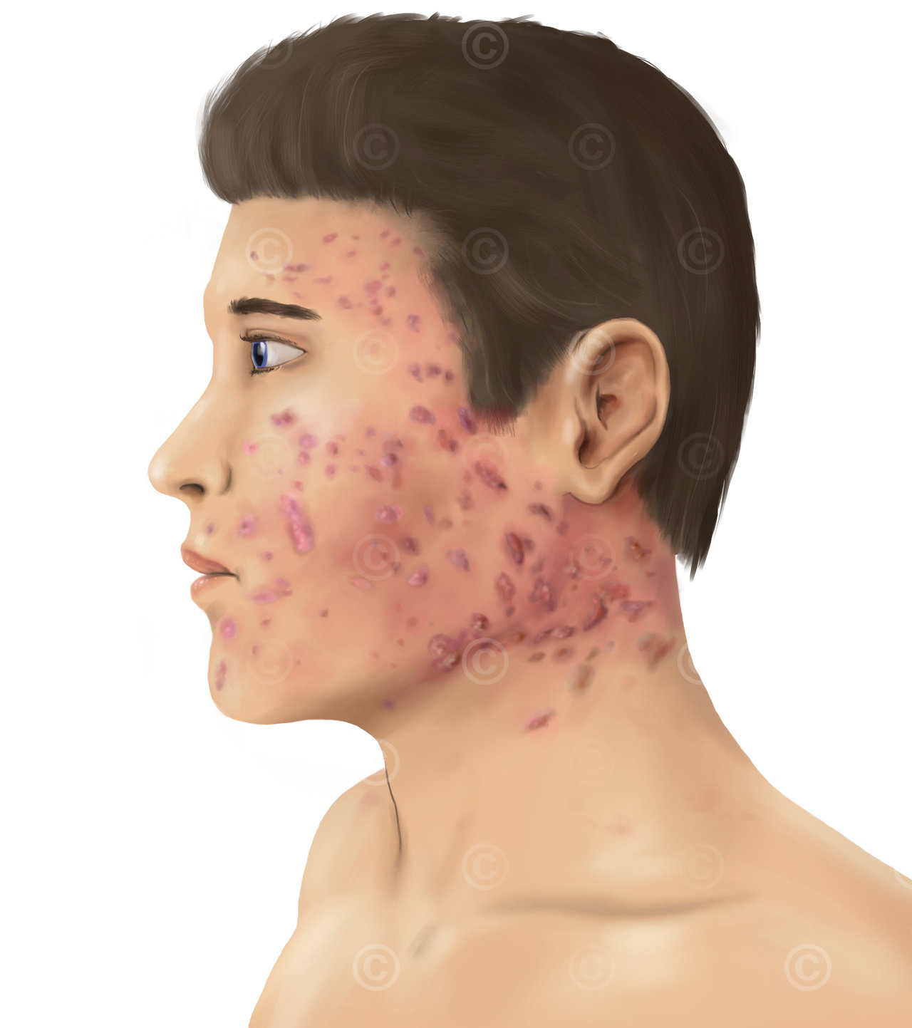 Illustration Acne vulgaris