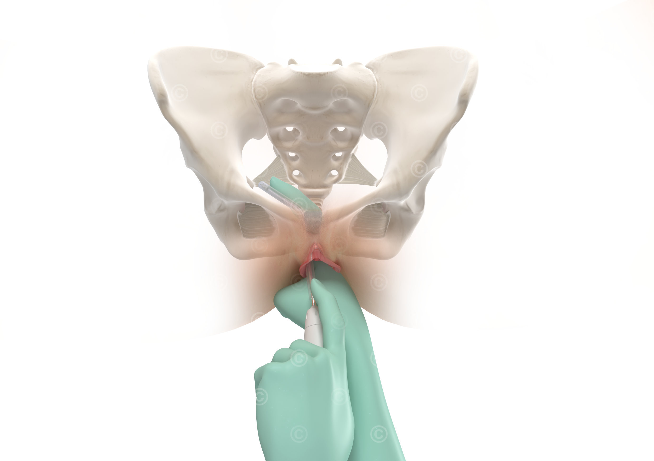 mesh anchor ligamentum sacrospinale