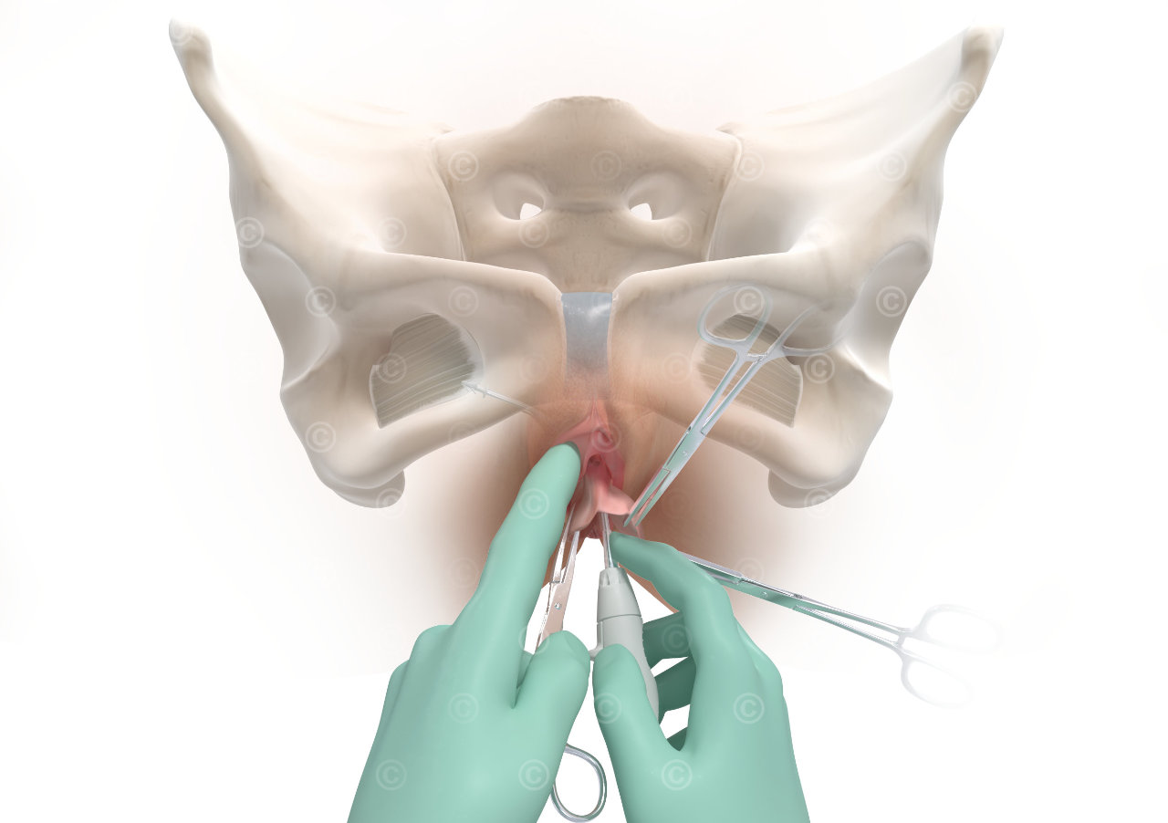 Pelvic floor surgery - installation network in m. obturator internus