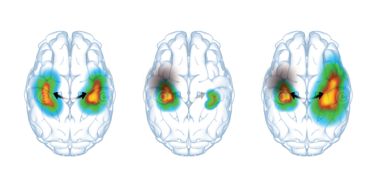 brain activation dysphagia stroke