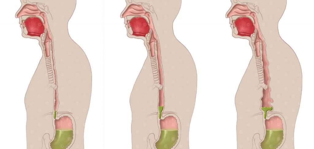 Grafiken Achalasie und Reflux MedicalGraphics