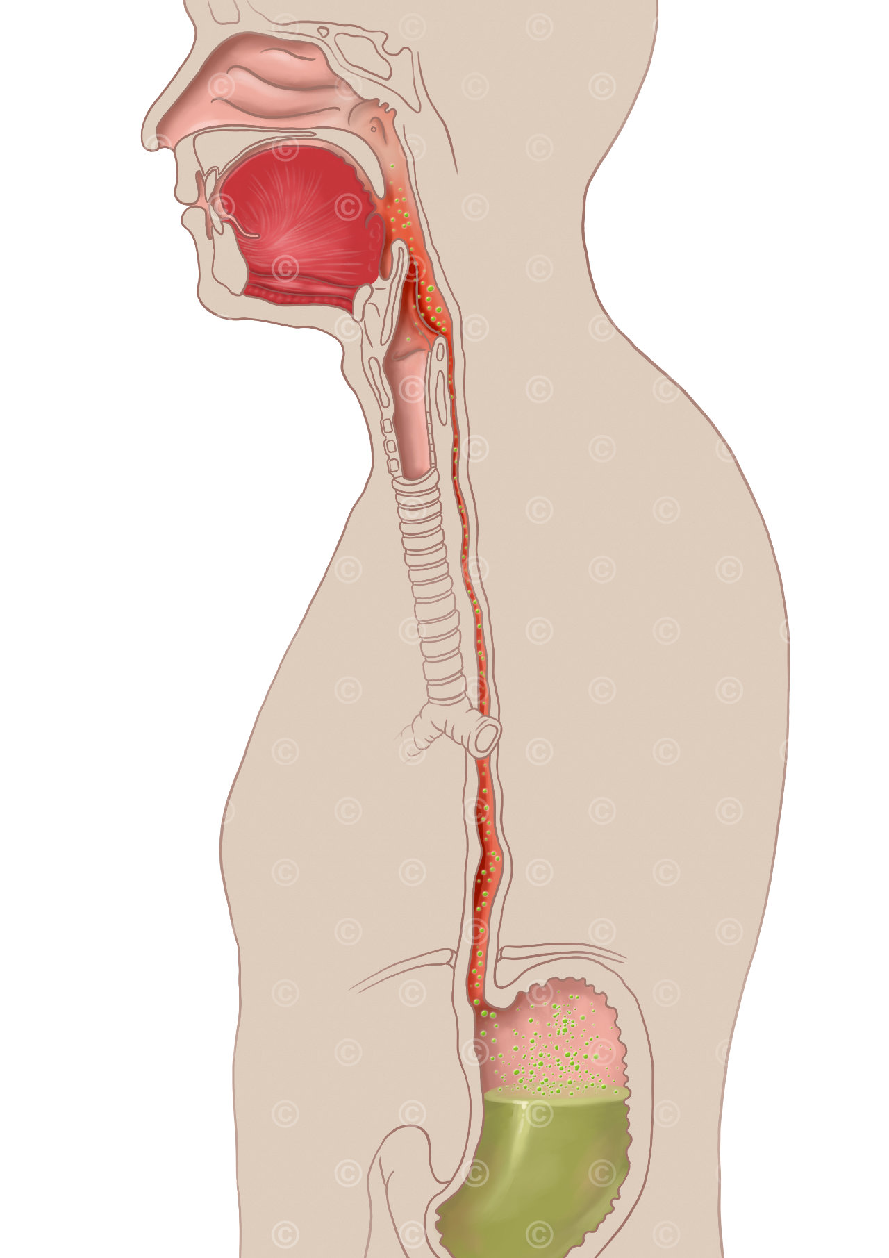   Gastroesophageal reflux disease