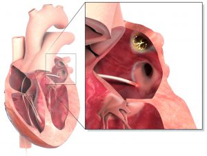 Animation Atria Thrombus in left atrium - MedicalGraphics
