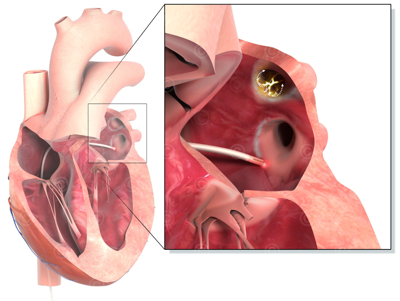 Ablation myocardium in the left atrium