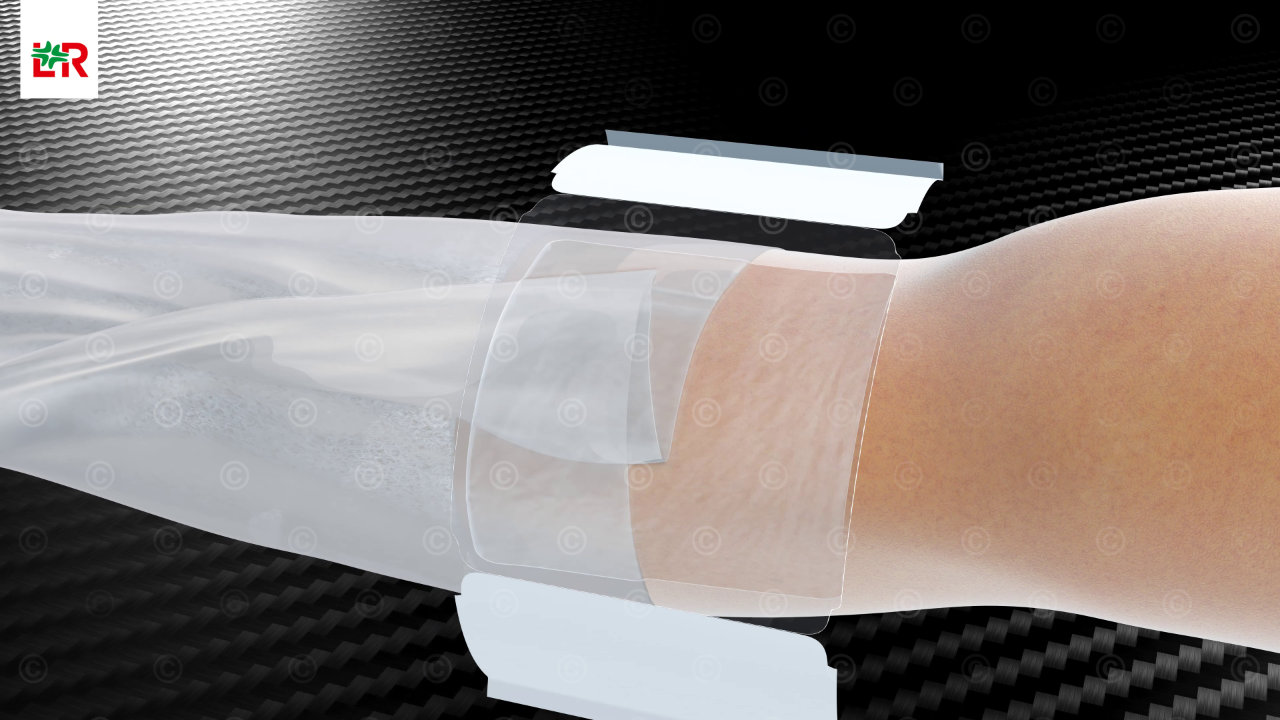 fix-secondary-dressing-wound