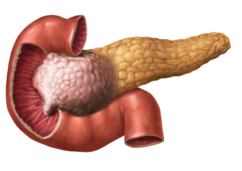 Pancreatic head carcinoma