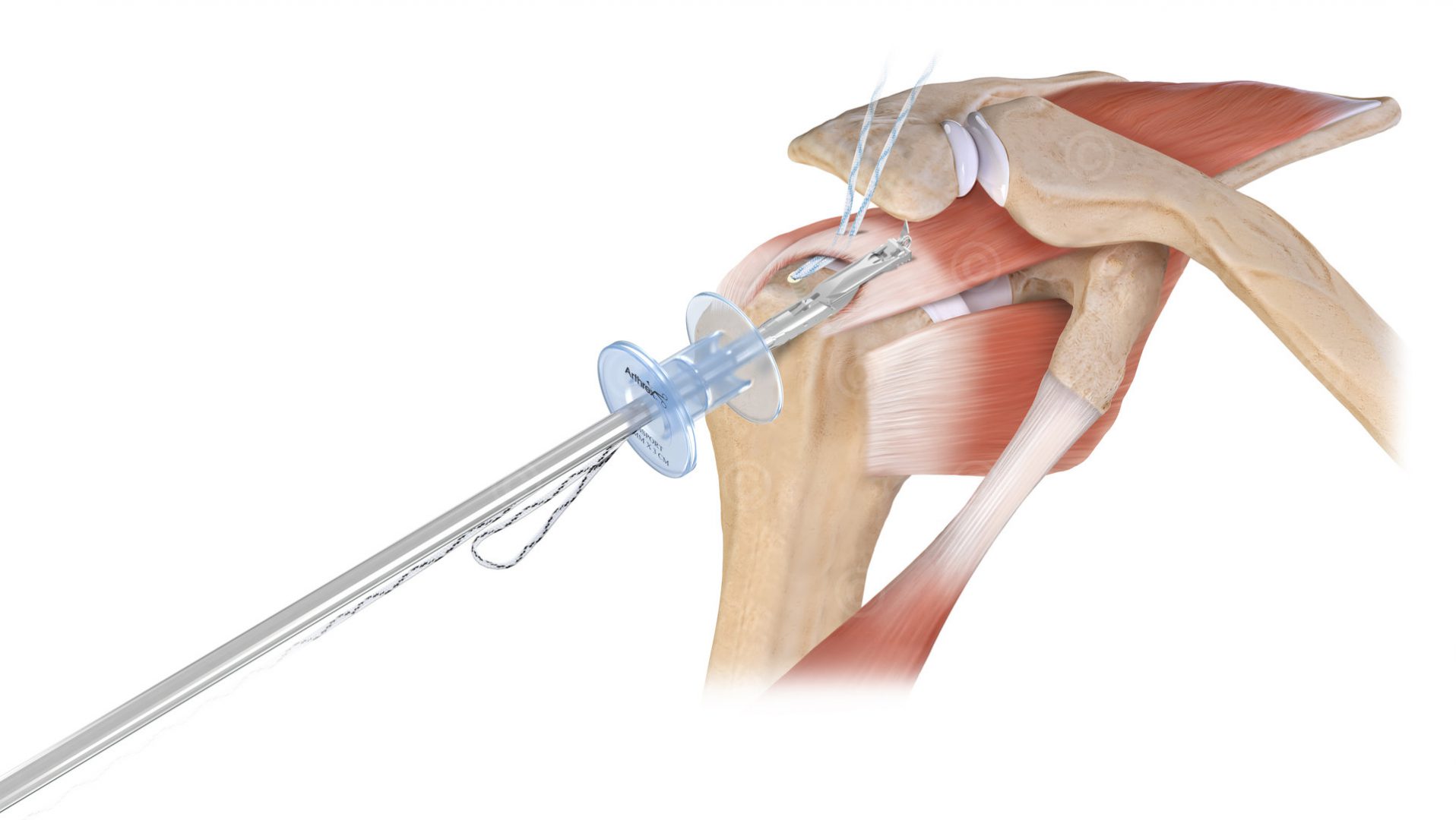 Faden mittels Scorpion durch Supraspinatus