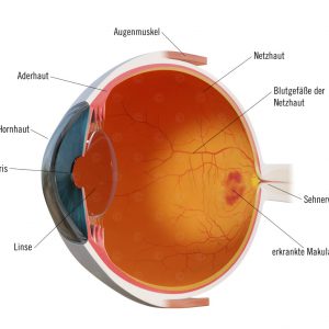 Sagittalschnitt Auge mit nAMD