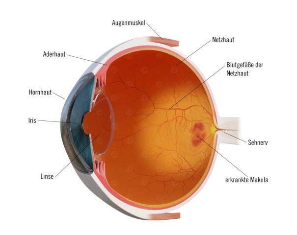 Sagittalschnitt Auge mit nAMD