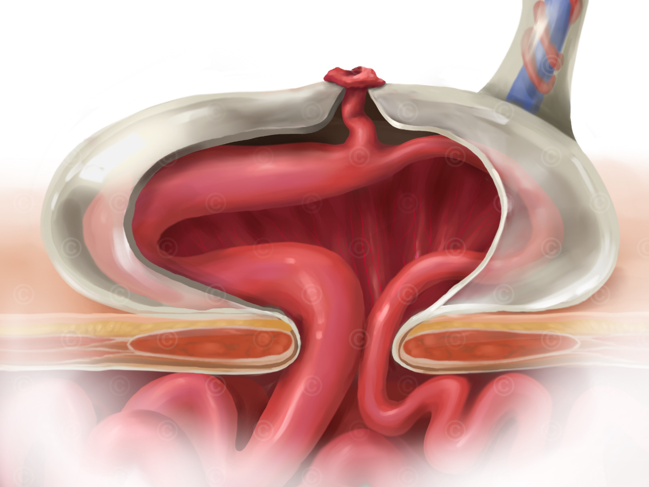  Omphalocele with omphalomesenteric duct