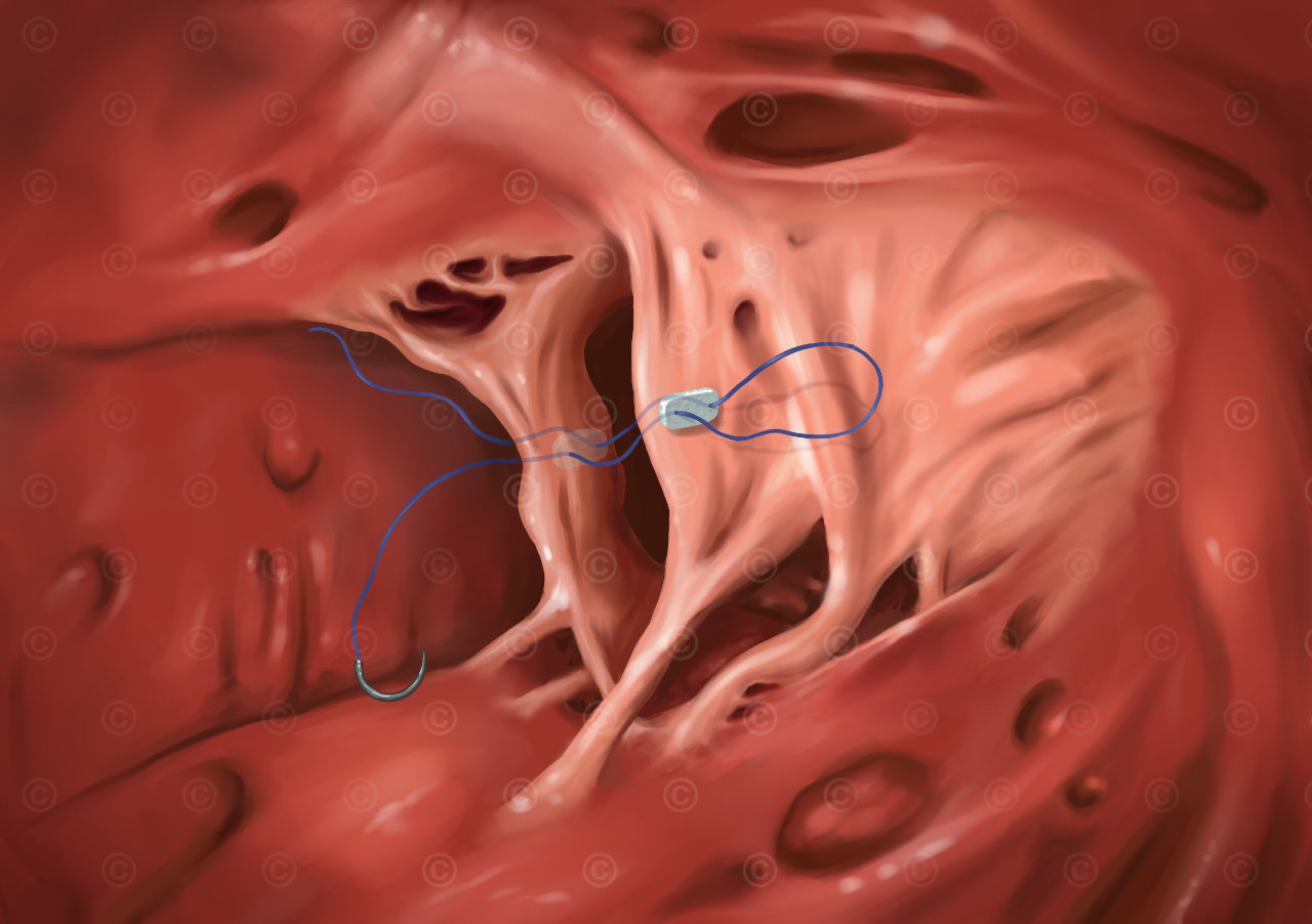 Alfieri stitch - surgery for mitral valve regurgitation