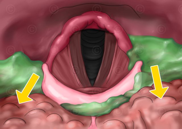 Delayed triggering of the swallowing reflex