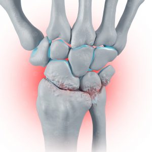 Wrist osteoarthritis - Stage 4