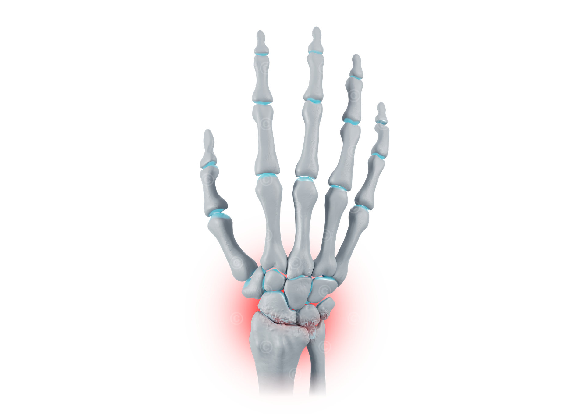 wrist osteoarthritis stage 4