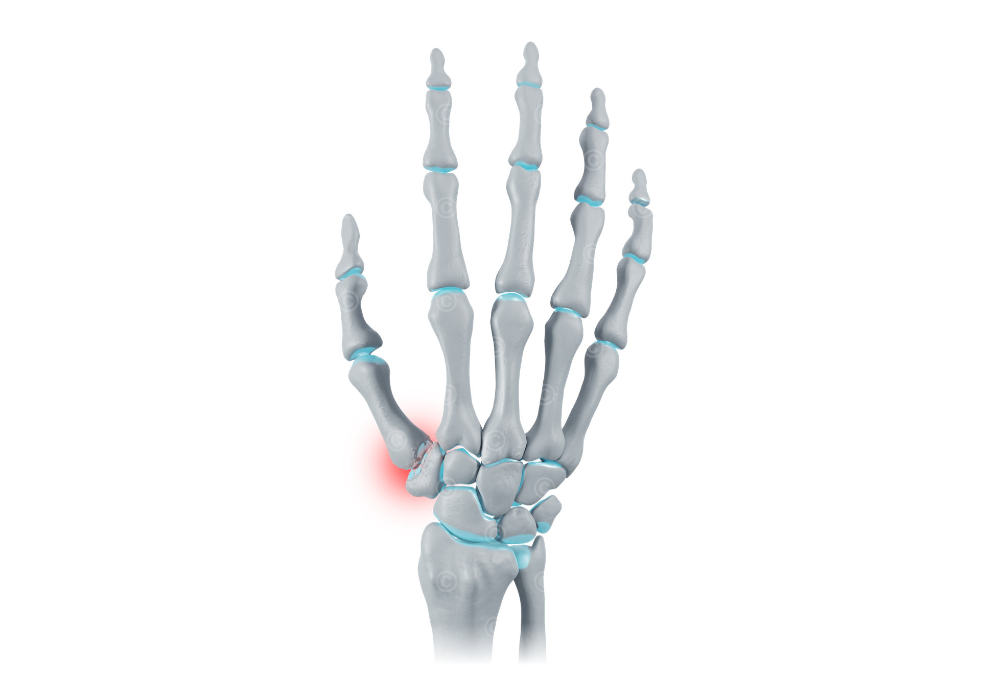 rhizarthrosis stage 3