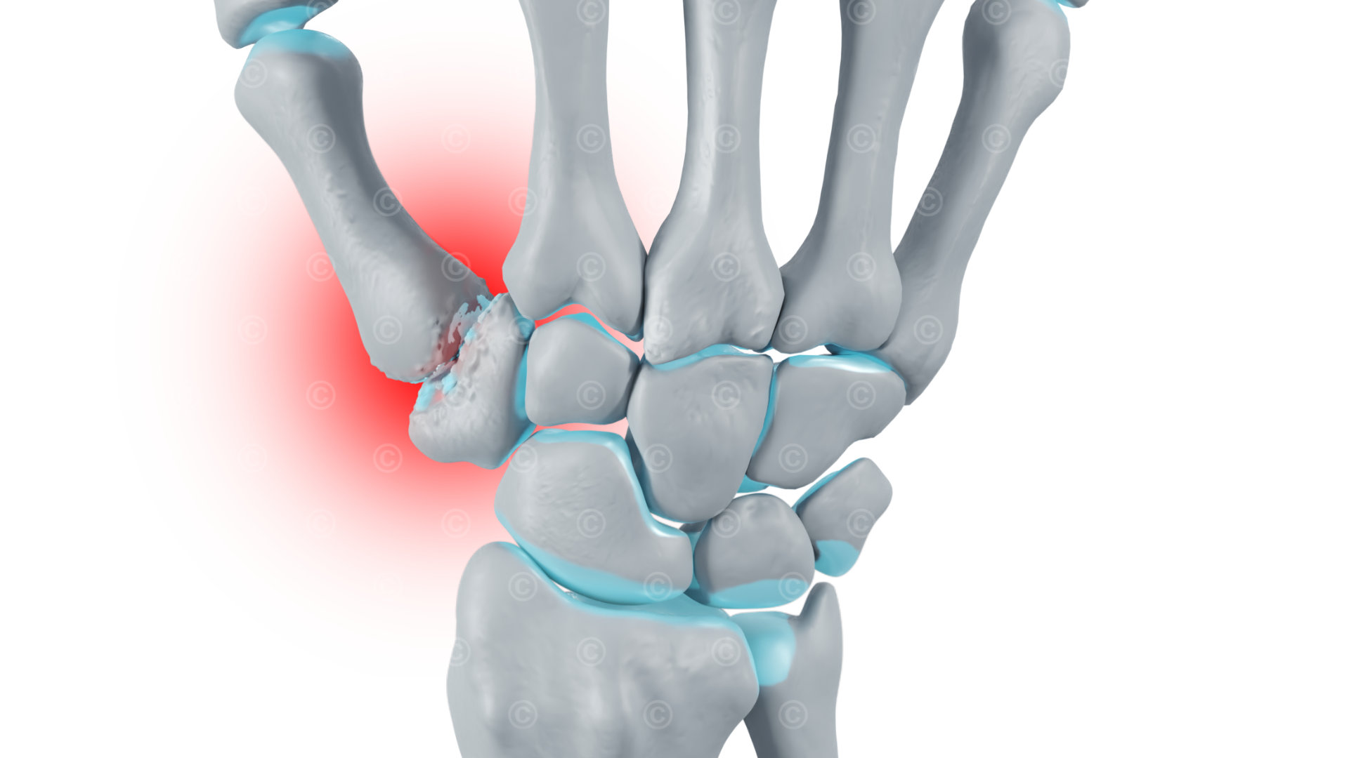 Rhizarthrosis - stage 4