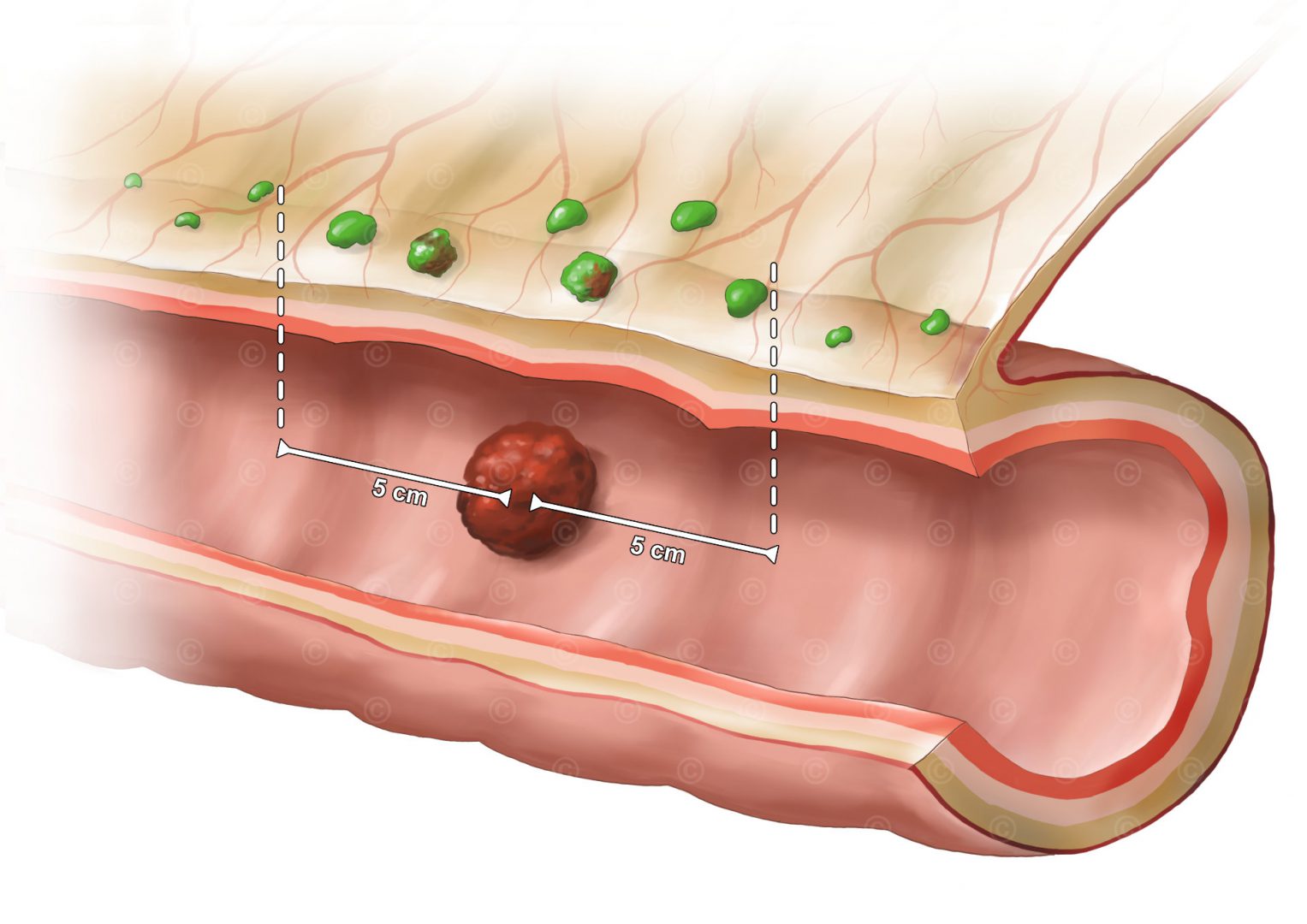 Colorectal cancer - lymph nodes