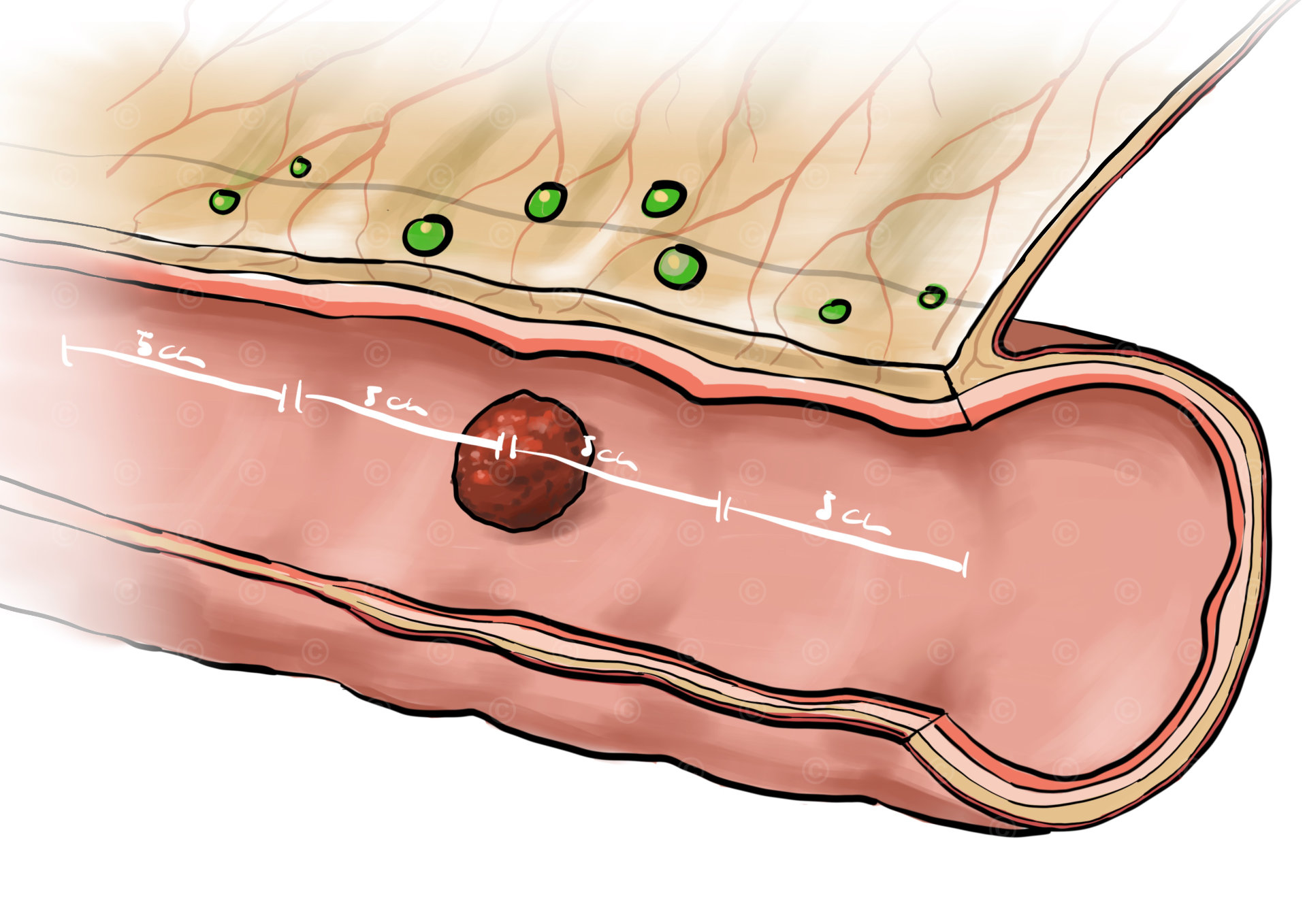 Sketch for the communication content colorectal carcinoma