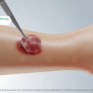 Easy removal of wound dressing Suprasorb A Pro